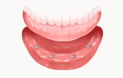 전체임플란트 틀니 중 고민 중이라면 (임플란트틀니) 관련 이미지 4