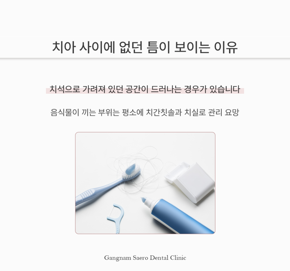 스케일링 후 이가 시리고 벌어졌다? 스케일링부작용 오해와 진실 관련 이미지 4