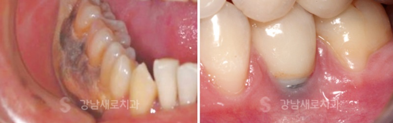 강남역임플란트, 치과 고를 때 주의할 점 <필독> 관련 이미지 5