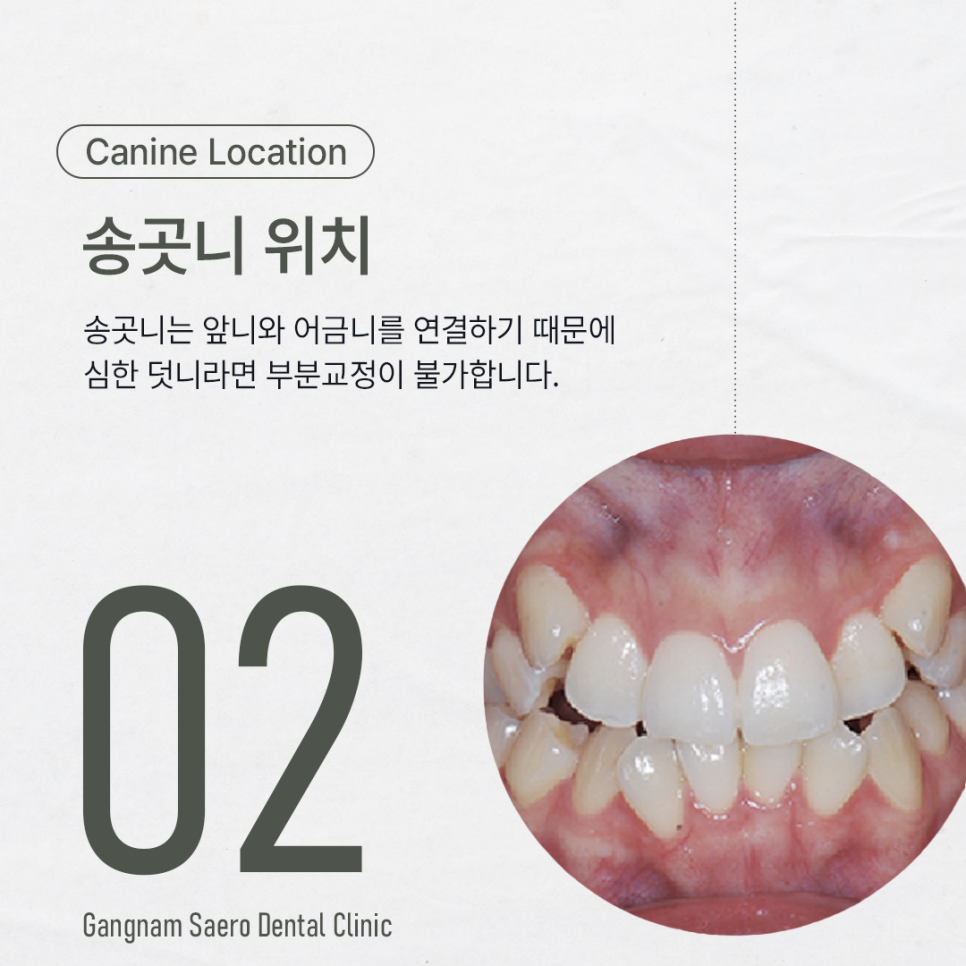 앞니만 교정하고 싶다면 부분만 교정하는 (앞니교정) 관련 이미지 3