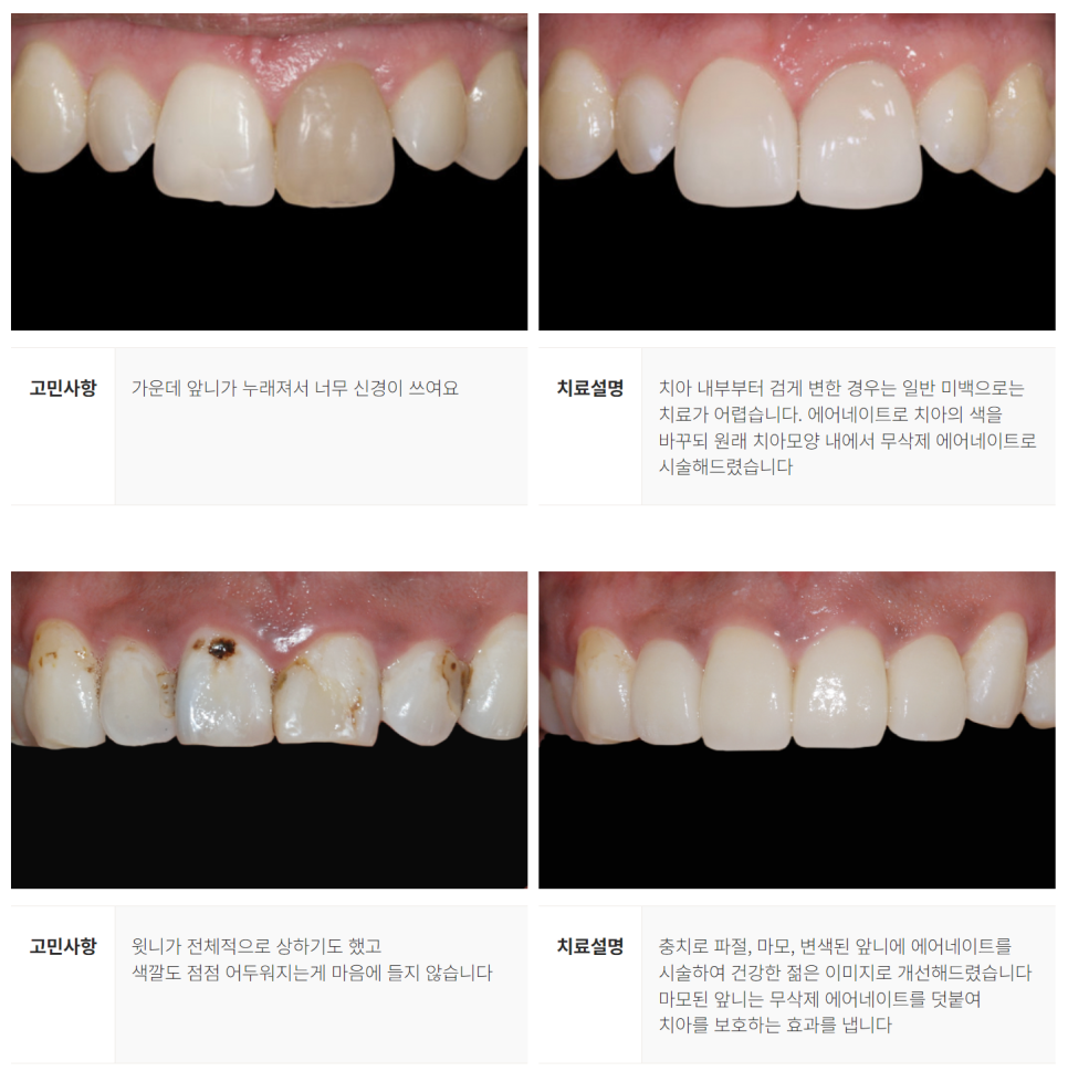 라미네이트 대체 시술 에어네이트 (치아 컴플렉스 해결 방법) [ 강남새로치과 ] 관련 이미지 9