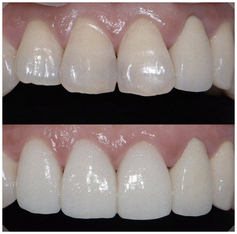 누런 앞니가 고민이라면? 원인과 해결 방법 관련 이미지 5