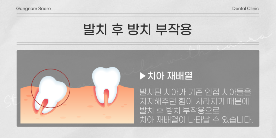 발치 후 꼭 임플란트 해야 하나요? (임플란트안하면) 관련 이미지 3