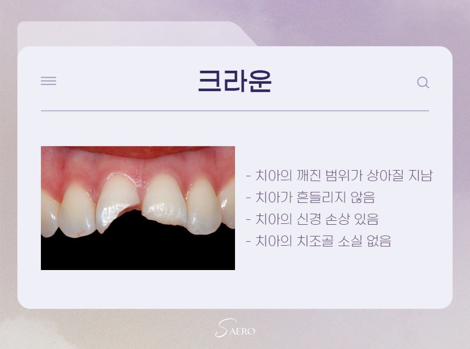 치아크랙 치료 방법? 레진, 라미네이트, 크라운, 임플란트 (앞니깨졌을때) 관련 이미지 6