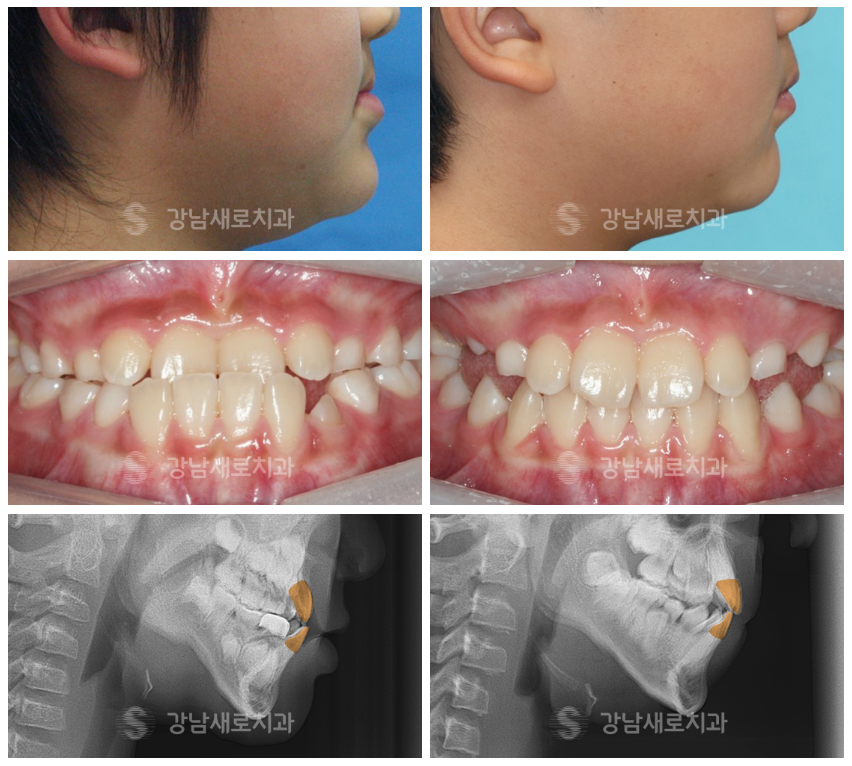 어린이주걱턱 조기에 치료해야 수술 없이 가능해요! (어린이주걱턱) 관련 이미지 5