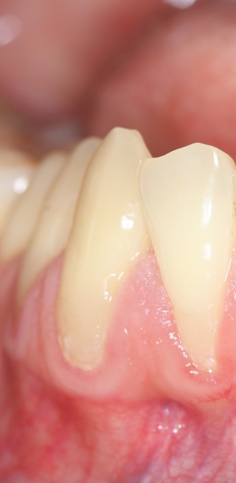 구강질환을 예방하는 치주질환치료 관련 이미지 1