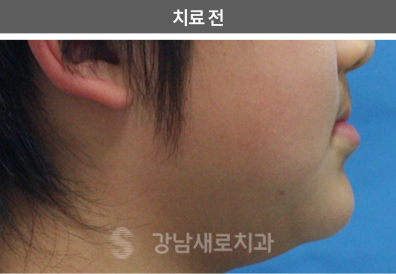 유아 주걱턱교정, 올바른 뼈 성장을 위한 방법 관련 이미지 4