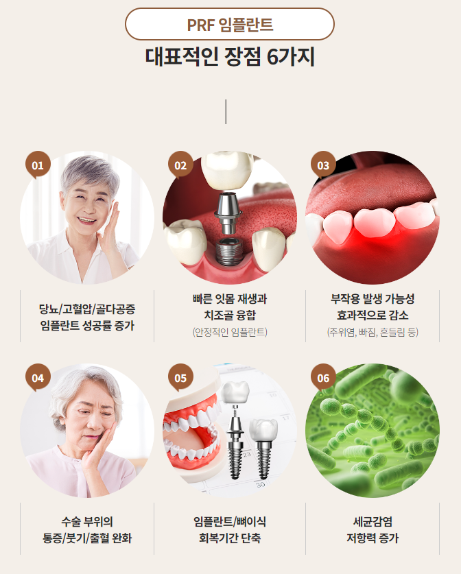 최소식립으로 최대효율 전체임플란트 (65세임플란트) 관련 이미지 4