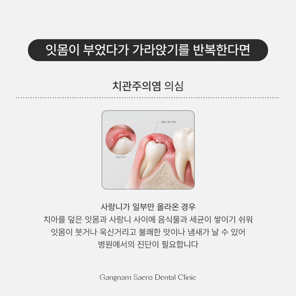사랑니발치, 꼭 뽑아야 하나요? 통증 식사 흡연 안내 관련 이미지 3