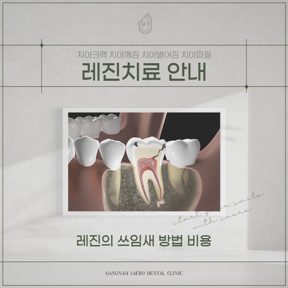 치아크랙 치아깨짐 치아벌어짐 치아파절 (레진치료 안내) 관련 이미지 1