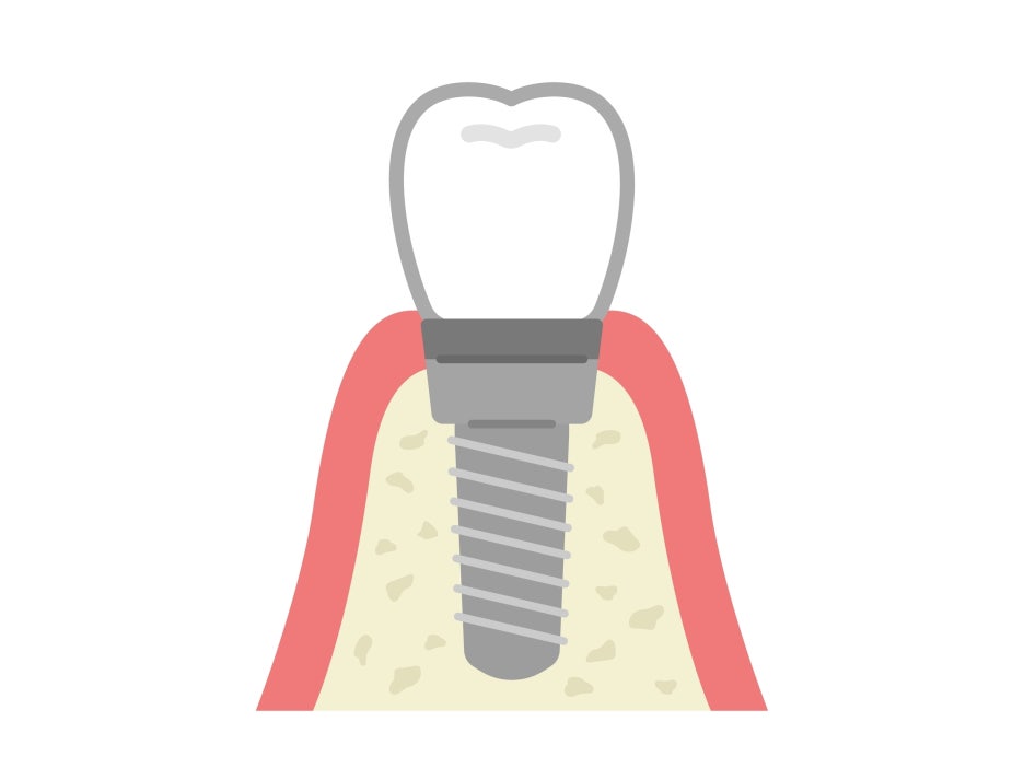 임플란트 후 식사, 어떤 음식 섭취가 좋을까요? 주의 사항은 뭘까요? 관련 이미지 1