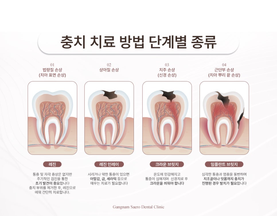 What If Your Dentist Says a Severely Decayed Tooth Needs to Be Extracted? (Reasons for Extraction Due to Tooth Decay) image 2