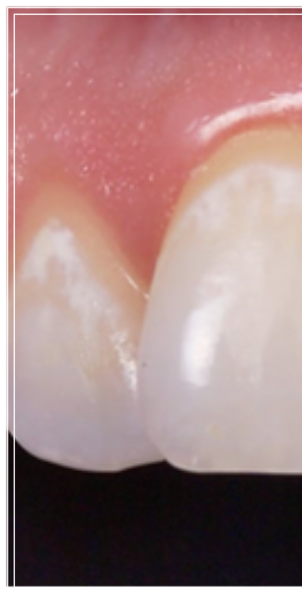 탕후루 치아 손상을 유발? 치료 방법 및 후기 관련 이미지 4