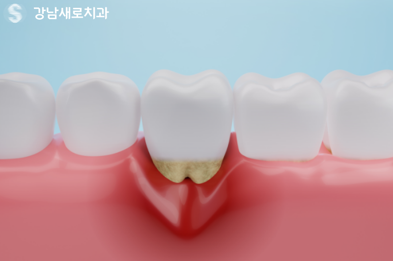 강남역잇몸염증치료, 잇몸피가 나는 원인의 치료방법? 관련 이미지 3