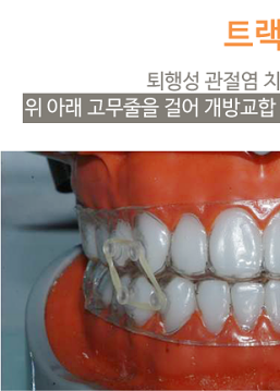 턱통증 치료, 비수술로 해결하는 방법 관련 이미지 5