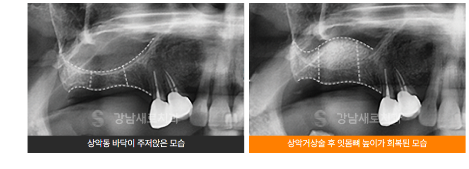 안전한 윗니 임플란트 (상악동거상술) 관련 이미지 3