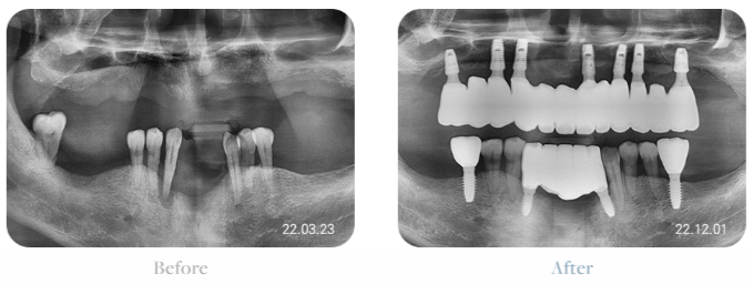 치아가 얼마 안 남은 65세이상임플란트 (전체임플란트후기) 관련 이미지 6