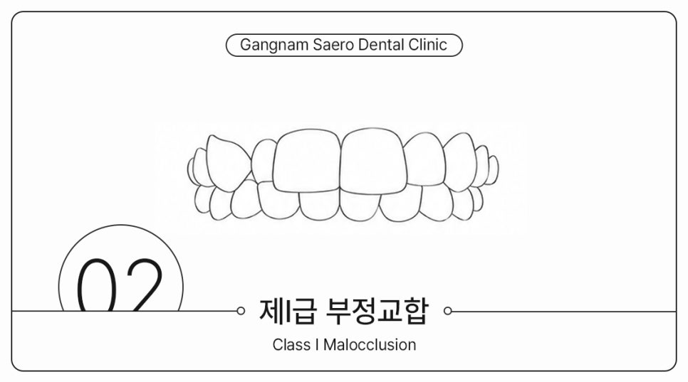 부정교합 개방교합 과개교합 투명교정으로 가능할까요? (주걱턱교정기 돌출입교정기) 관련 이미지 4