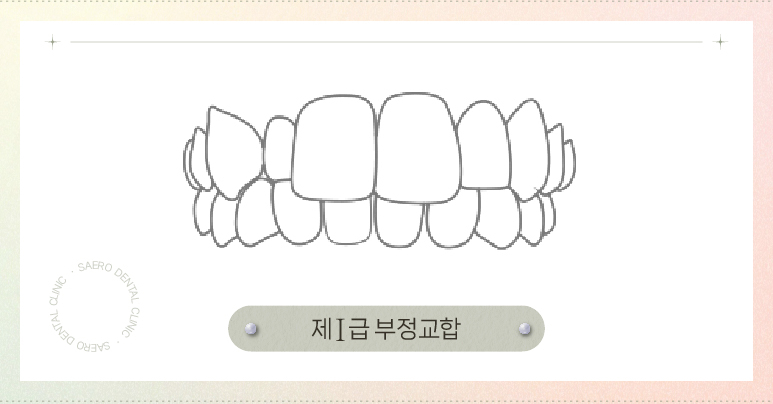 부정교합 투명교정으로 교정이 되나요? (부정교합교정) 관련 이미지 4