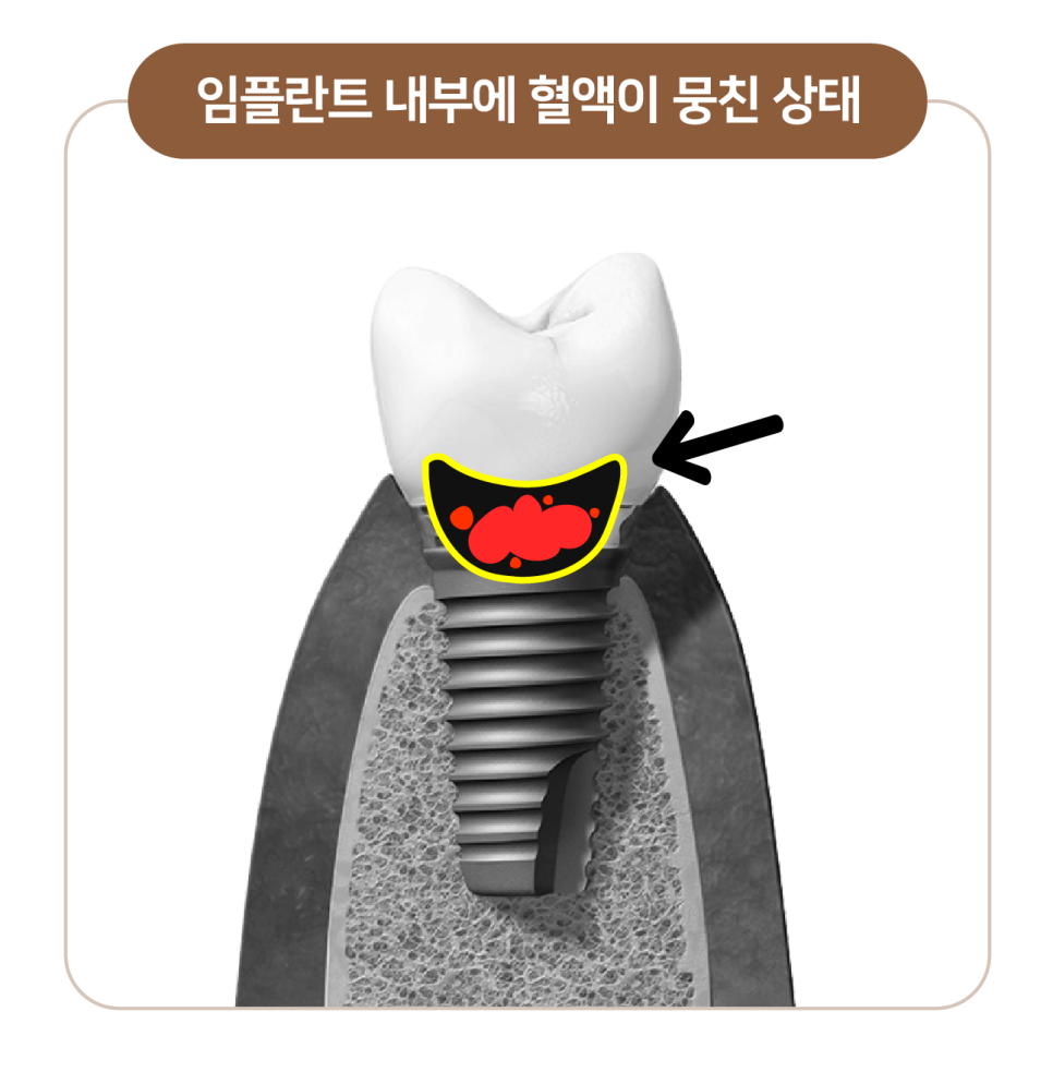 임플란트 부작용 자세히 알아보기(1) 임플란트 보철 (크라운, 지대주, 픽스쳐) 부작용 [ 예방 및 대처 방법 ] [ 강남새로치과 ] 관련 이미지 5