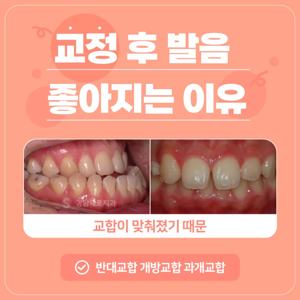 연예인 아나운서 지망생 교정 (교정하면 발음이 안 좋아지나요?) [ 강남새로치과 ] 관련 이미지 5