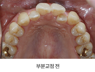 4개월 급속교정 (전체교정은 부담스럽다면 부분교정) [ 강남새로치과 ] 관련 이미지 4