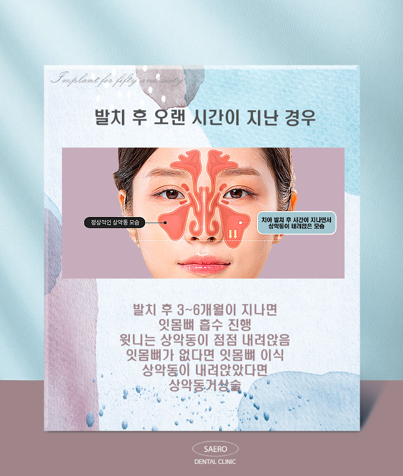 부모님세대 5060을 위한 임플란트 (상악동거상, 당뇨, 고혈압, 골다공증, 무치악 임플란트) 관련 이미지 2