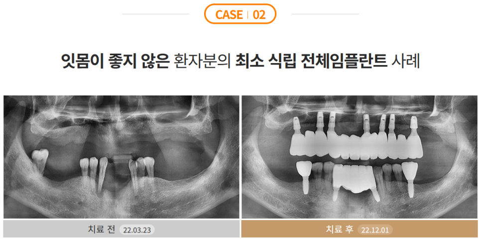 전체임플란트 부작용 최소화하려면 (성공률 높은 임플란트) 관련 이미지 4