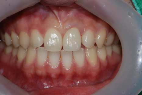 법랑질 삭제를 최소로 하는 헨리라미네이트 관련 이미지 6