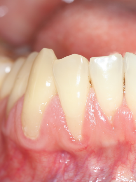 잇몸뼈 녹음이 발생하는 원인과 해결 방법 관련 이미지 2