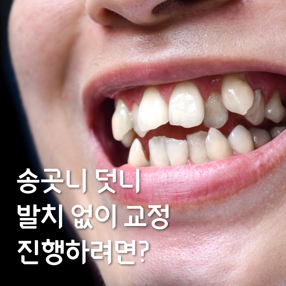 송곳니덧니교정을 발치 문제 없이 진행할 수 있다면? 관련 이미지 1