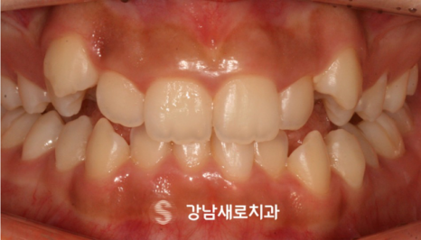 송곳니 덧니 교정없이 방치하면 발생하는 문제? 관련 이미지 4