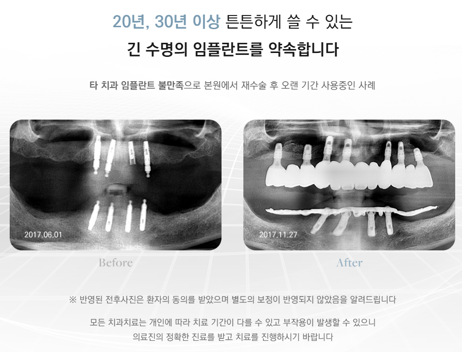 Combining the Advantages of Implants and Dentures (Implant Denture) image 6