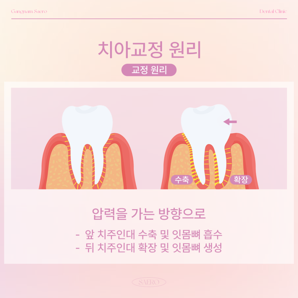 교정얼굴변화 부작용 안내 (옥니, 팔자주름, 인중 길어짐 등) 관련 이미지 2