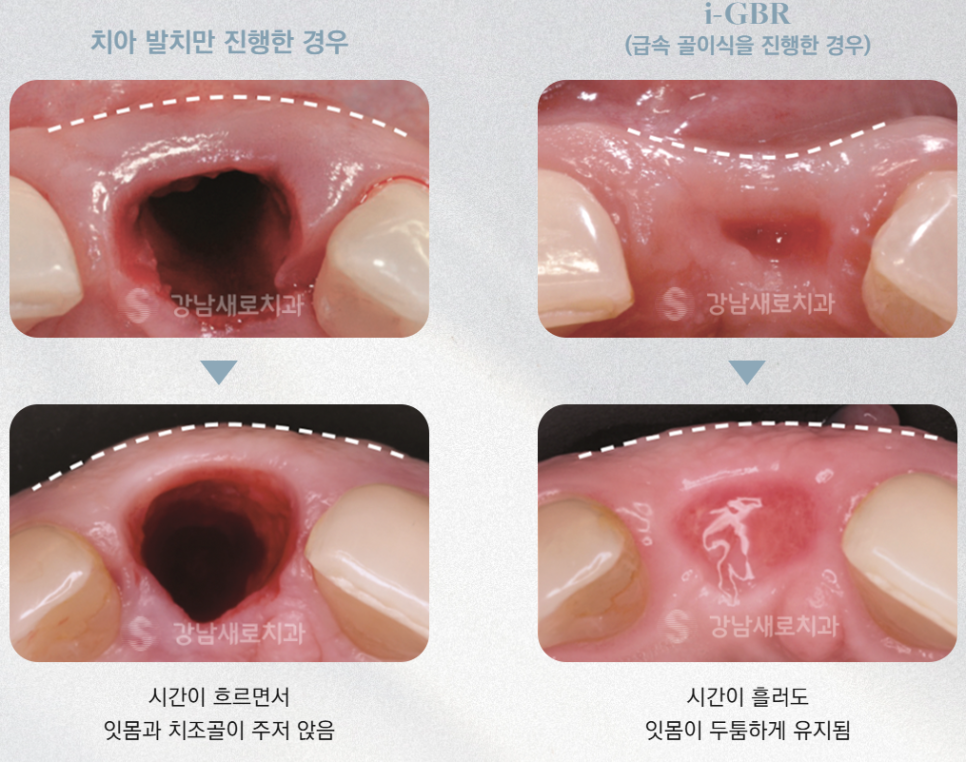 Dental Implant Side Effects: Gums (Periodontal and Gum Tissue Damage) — Prevention and Management image 8