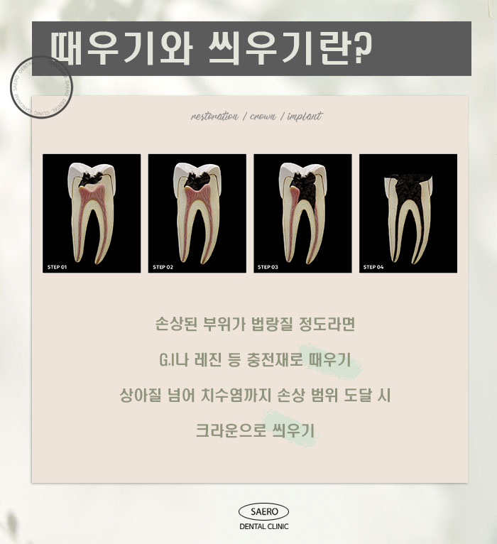 충치치료 치아때우기와 치아씌우기 (20대임플란트 30대임플란트) 관련 이미지 2