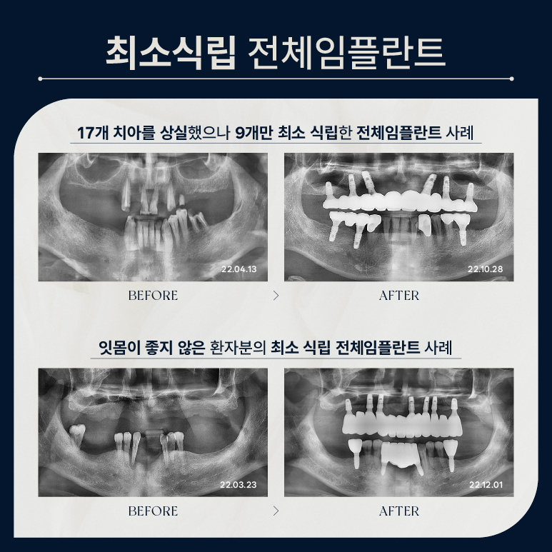 전체임플란트 비용 부담 줄이는 방법 (전체임플란트비용) 관련 이미지 3