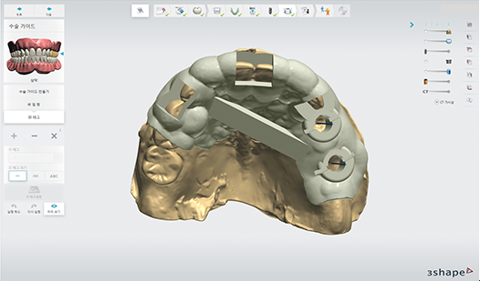 오차 줄이는 네비게이션임플란트 (붓기, 출혈, 통증 줄이는 임플란트) 관련 이미지 2