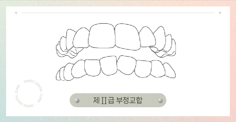 부정교합 투명교정으로 교정이 되나요? (부정교합교정) 관련 이미지 5