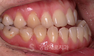 유아 주걱턱교정, 올바른 뼈 성장을 위한 방법 관련 이미지 7