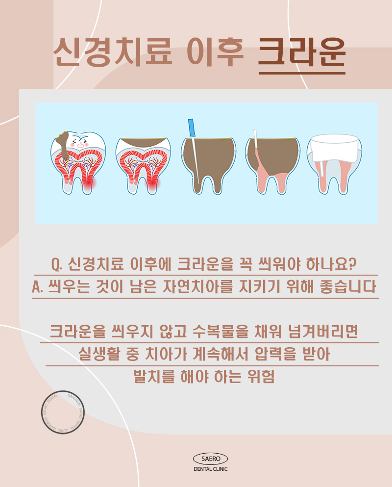 신경치료 이후 충치씌우기 크라운 안내 (크라운 종류와 선택 방법) 관련 이미지 2