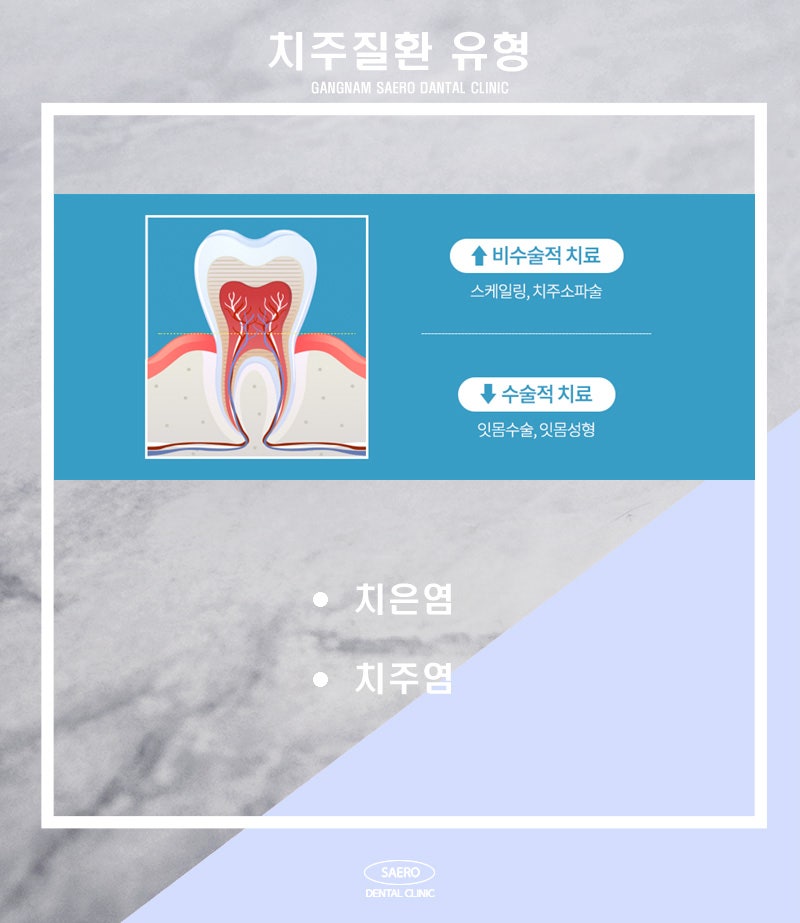 갑자기 잇몸 부을 때 정확한 원인과 올바른 해결 방법 (잇몸부음이유) 관련 이미지 4