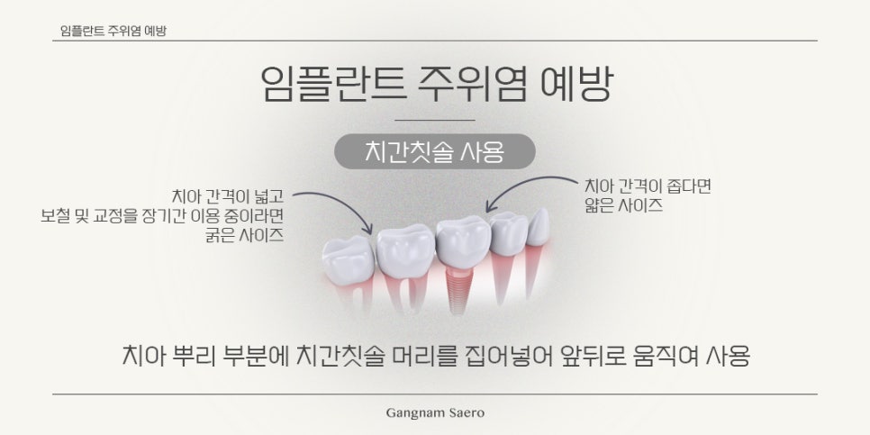 임플란트 수술 후 주의사항 (임플란트사후 임플란트관리) 관련 이미지 3