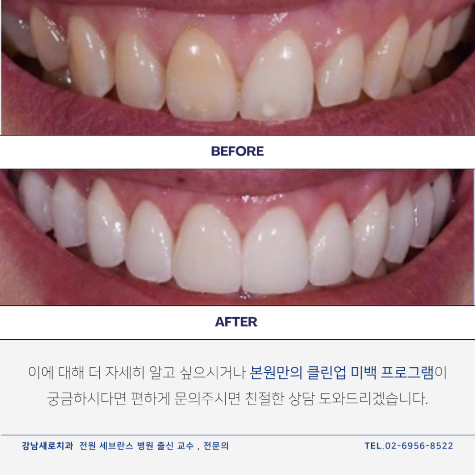 셀프치아미백제, 구매 전 반드시 확인해야 하는 관련 이미지 13