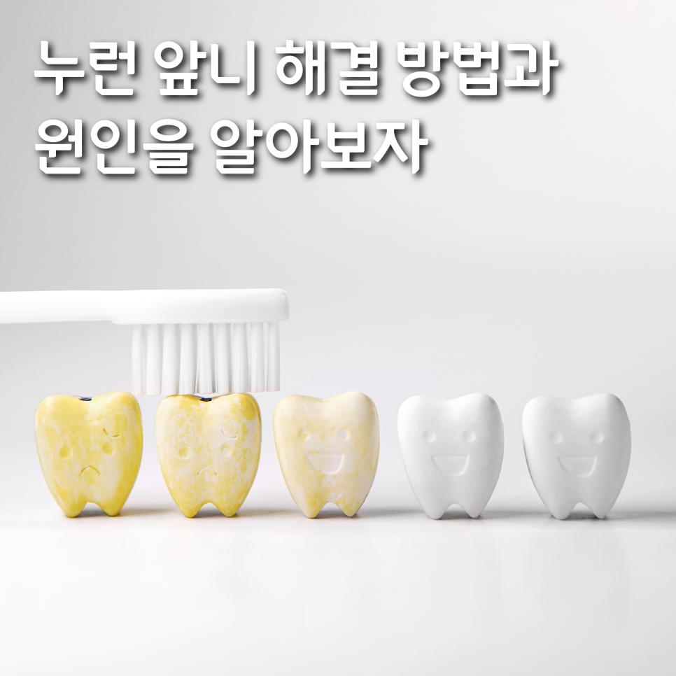 누런 앞니 해결 방법과 원인을 알아보자 관련 이미지 1