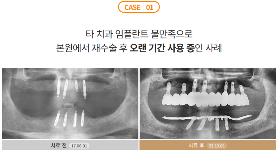 전체임플란트 부작용 최소화하려면 (성공률 높은 임플란트) 관련 이미지 5