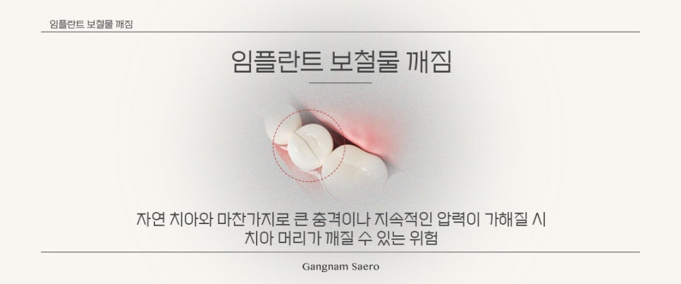 임플란트 수술 후 주의사항 (임플란트사후 임플란트관리) 관련 이미지 6