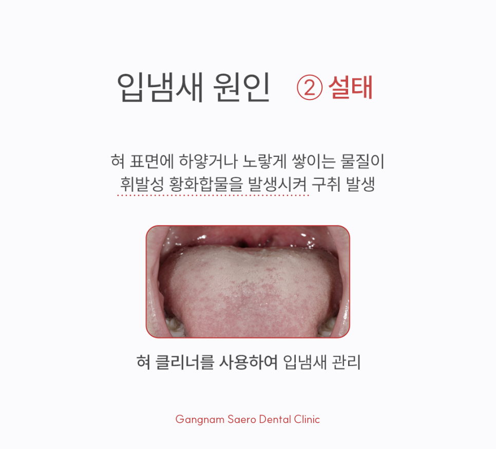 Bad Breath Clinic: What If You Have Bad Breath Even Though You Brush Regularly? image 4