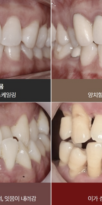 치은염 증상 어떠한 문제들이 있을까요? 관련 이미지 2