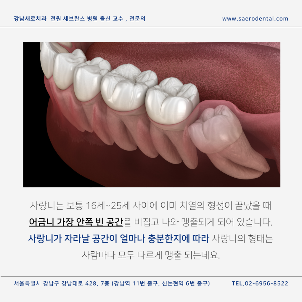 강남사랑니치과, 매복사랑니를 더욱 효율적으로 발치하려면 관련 이미지 1